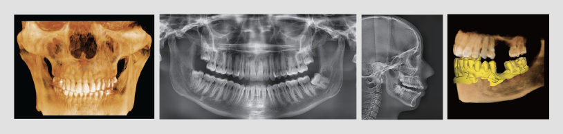 3D PaX-i Green 16 4u1 digitalni ortopan